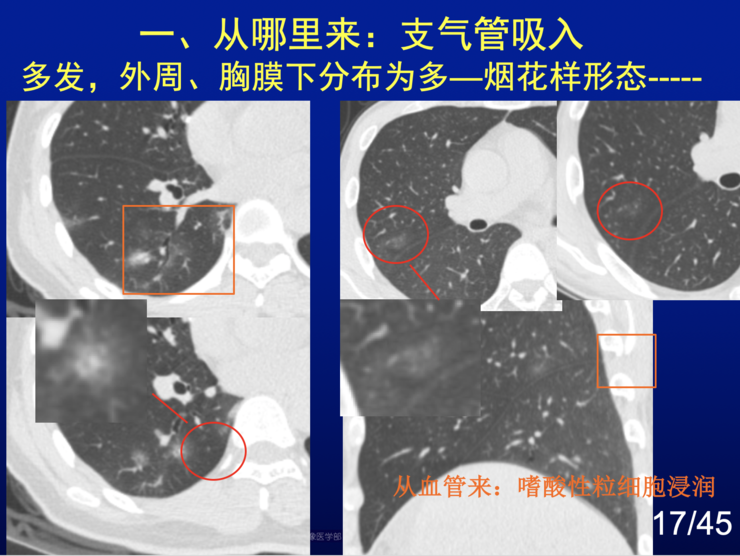 当基础病遇上新冠肺炎,双重风险下的生命防线 当基础病遇上新冠肺炎,双重风险下的生命防线