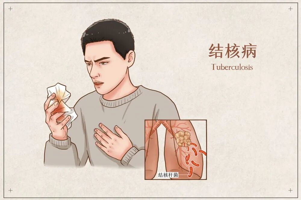 青岛确诊多数患结核,公共卫生的警示与应对 青岛确诊多数患结核,公共卫生的警示与应对