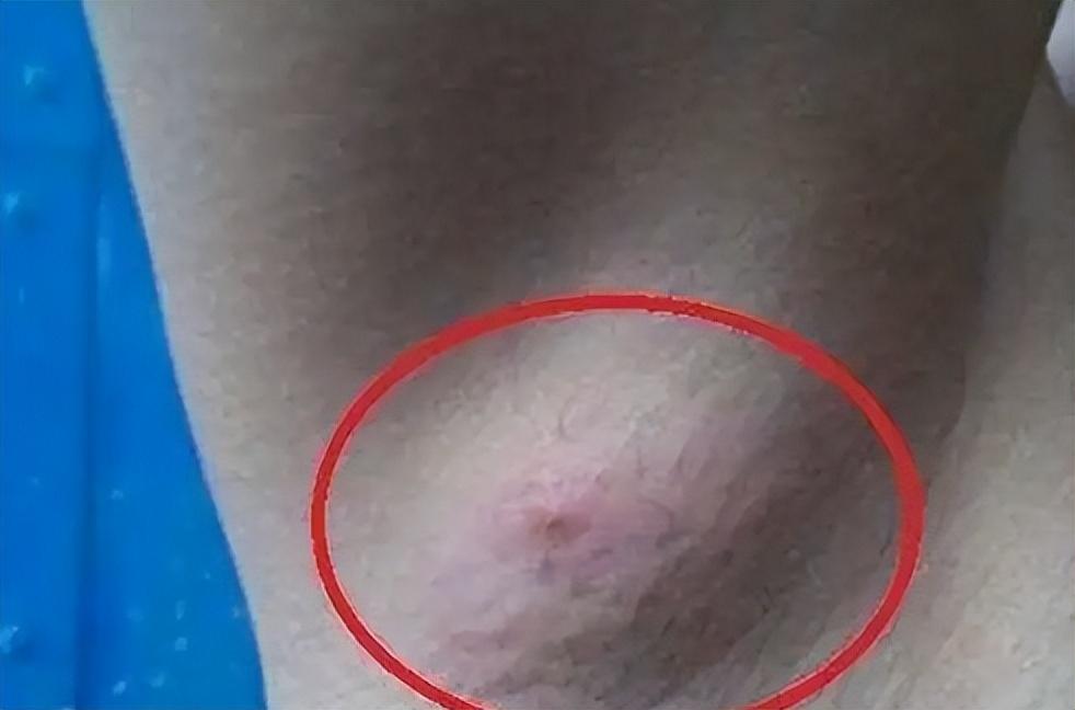 艾滋病初期症状概率多大（艾滋病初期预兆）