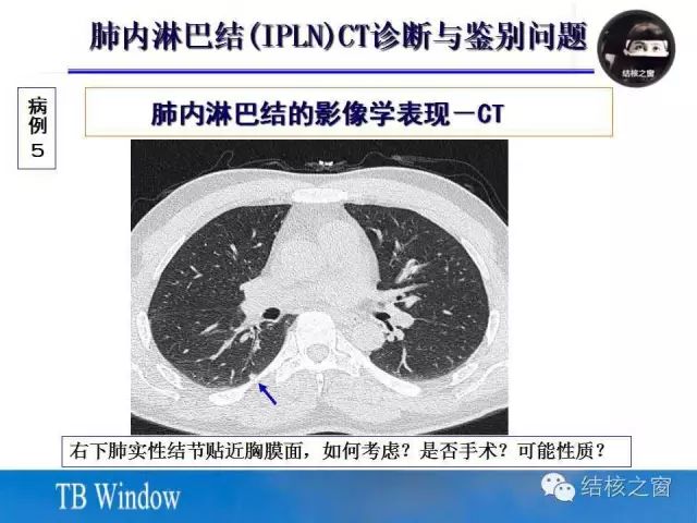 CT值-35HU严重么?解读肺部CT中的小白点 CT值-35HU严重么?解读肺部CT中的小白点