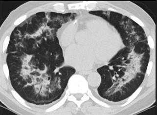 什么叫白肺病/肺炎白肺严重吗 什么叫白肺病/肺炎白肺严重吗