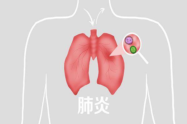 什么叫白肺病/肺炎白肺严重吗 什么叫白肺病/肺炎白肺严重吗