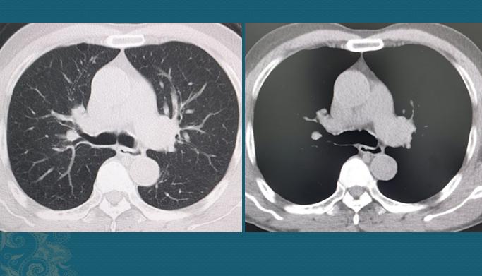 白肺能活多久/肺癌晚期出现白肺能活多久 白肺能活多久/肺癌晚期出现白肺能活多久