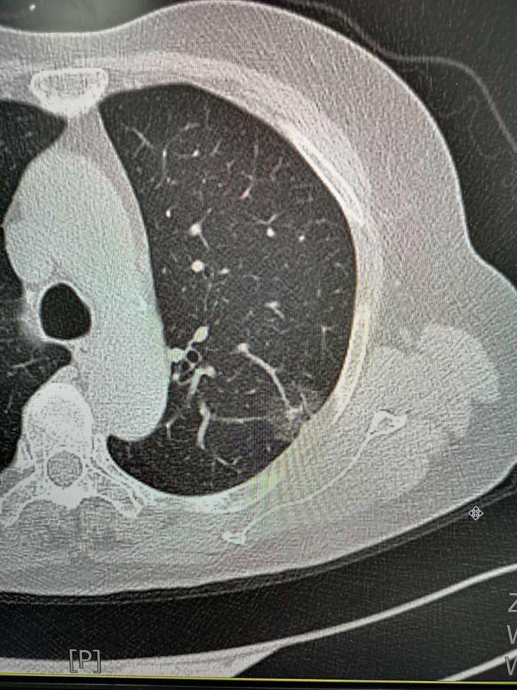 英国确诊新冠了要隔离吗:英国确诊新冠肺炎 英国确诊新冠了要隔离吗:英国确诊新冠肺炎