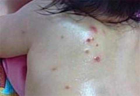 沈阳猴痘病毒图片/沈阳治疗猴子的医院