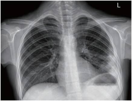 新型肺炎前几天的症状，警惕这些早期信号