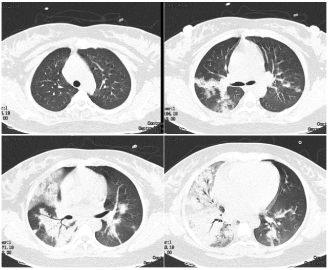 【新冠肺炎和发烧有什么区别,新冠肺炎和发烧有啥区别】