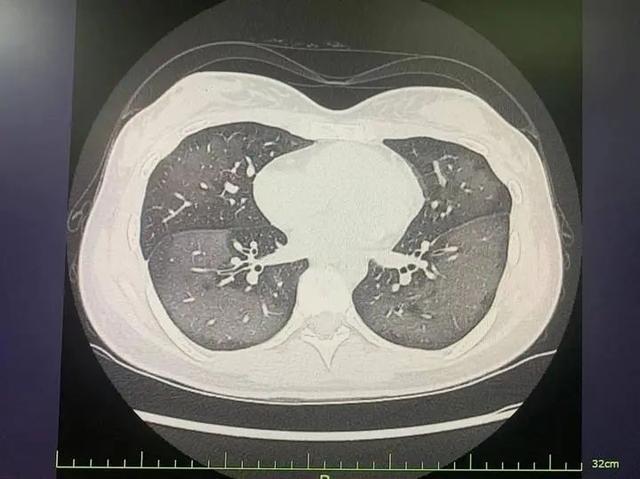 白肺现象，当呼吸被蒙上阴影