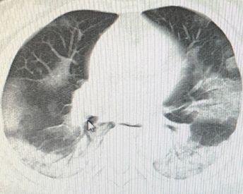 嘉兴桐乡肺炎最新消息:嘉兴桐乡新增病例