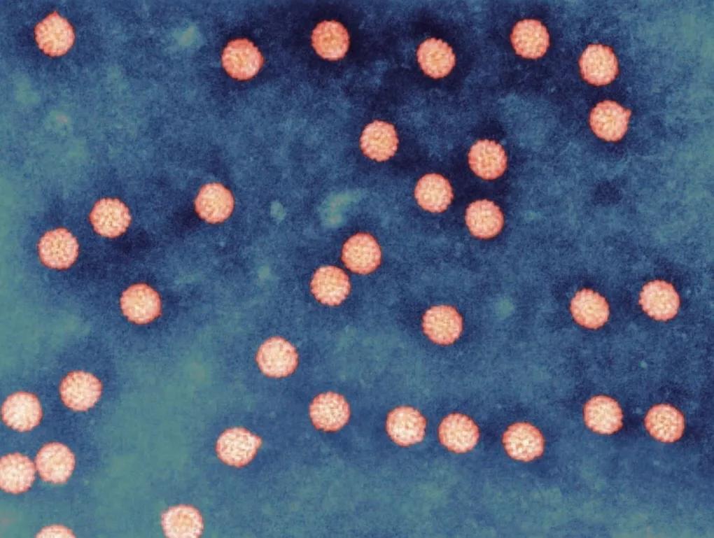 中东呼吸综合征（MERS）医学上的定义与全球影响