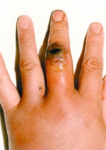 碳疽怎样读/碳疽的症状 碳疽怎样读/碳疽的症状