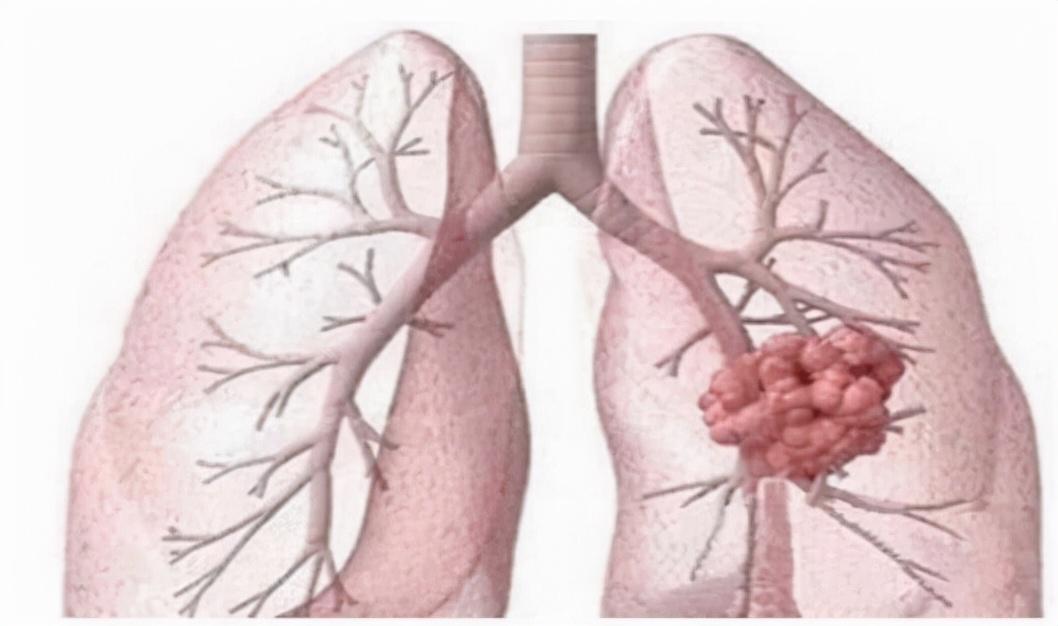 结核病疑似病例/肺结核疑似病例 结核病疑似病例/肺结核疑似病例