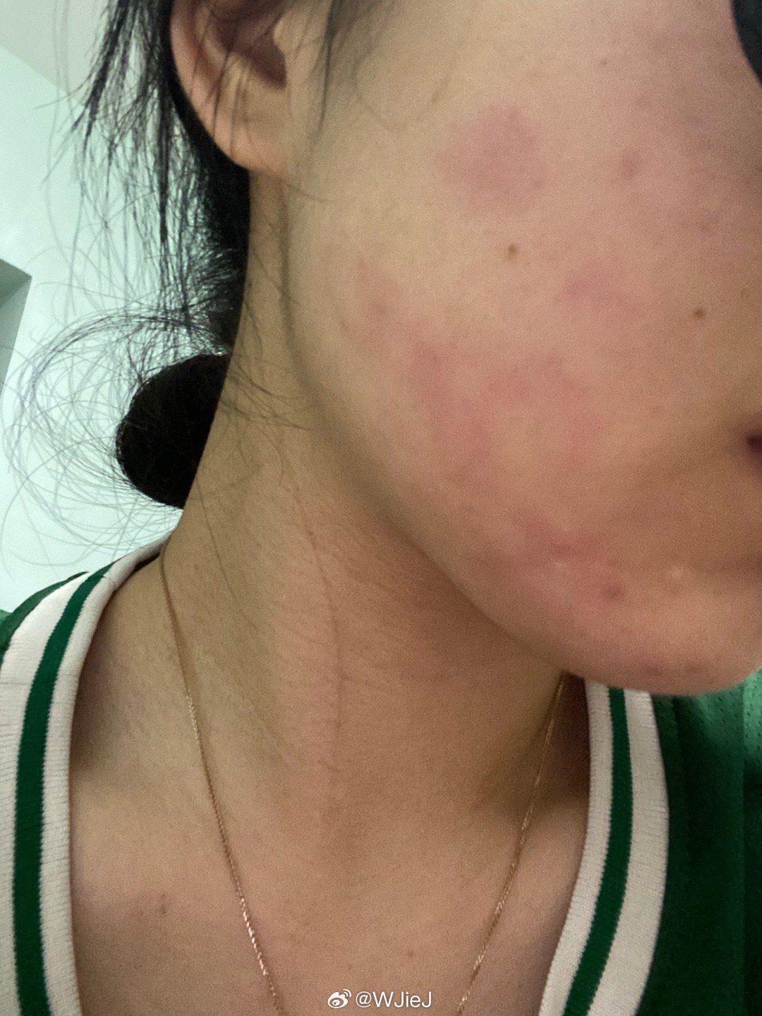 【过敏体质是不是不容易感冒/过敏是不是体质不好】