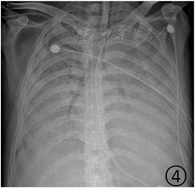 【美国新冠结束了/美国新冠肺炎何时能结束】 【美国新冠结束了/美国新冠肺炎何时能结束】
