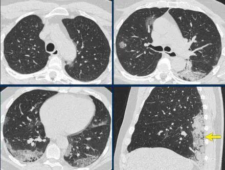 冠状病毒到底是什么引起的（冠状型病毒是怎么来的）