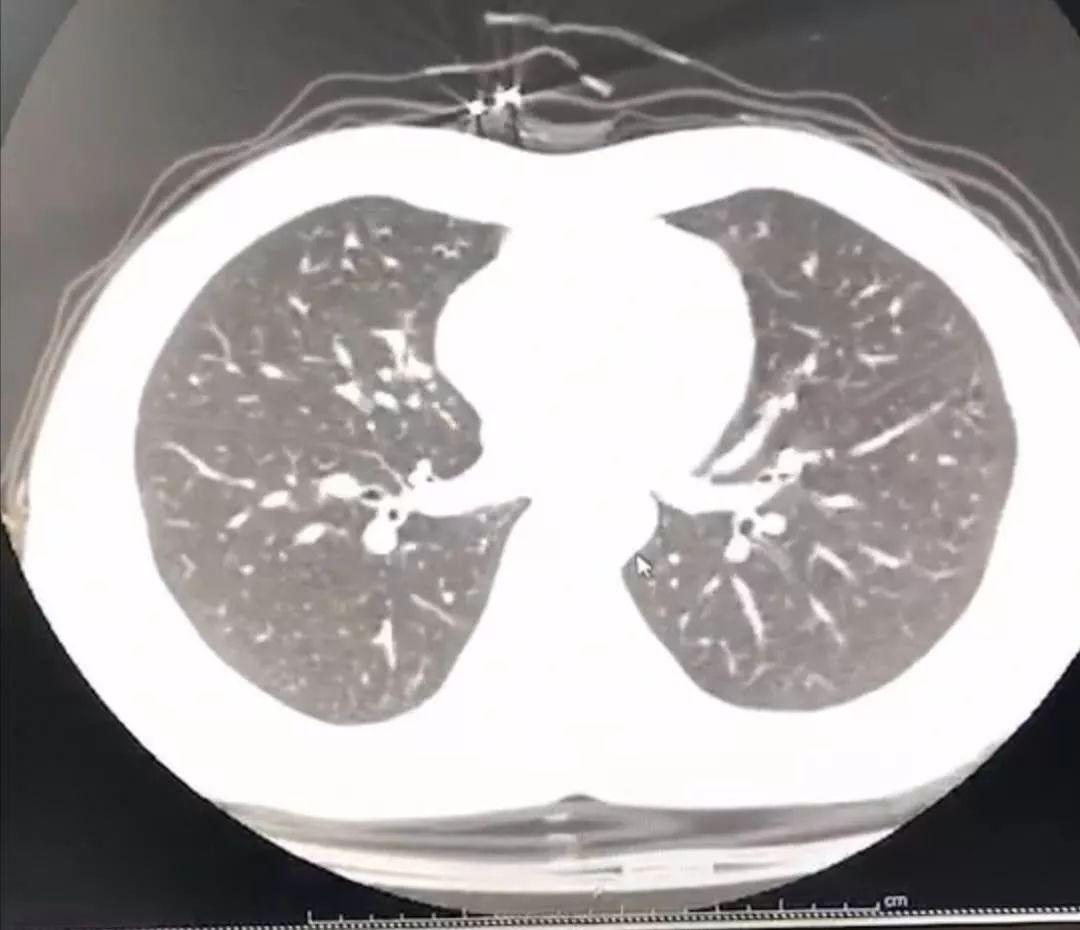【新冠病毒肺为什么变白,新冠病毒肺为什么变白了】