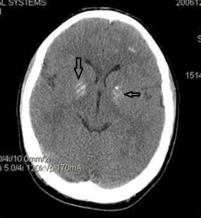 ct值35hu严重么:ct值约35hu ct值35hu严重么:ct值约35hu