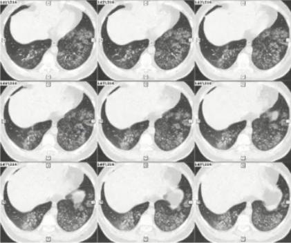 人型支原体核酸阳性是什么意思(人型支原体阳性的症状有哪些) 人型支原体核酸阳性是什么意思(人型支原体阳性的症状有哪些)